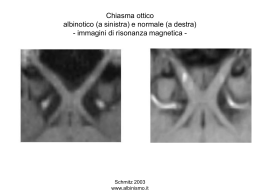 Chiasma ottico albinotico (a sinistra) e normale (a destra