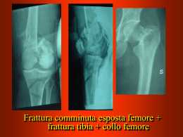 Frattura femore comminuta