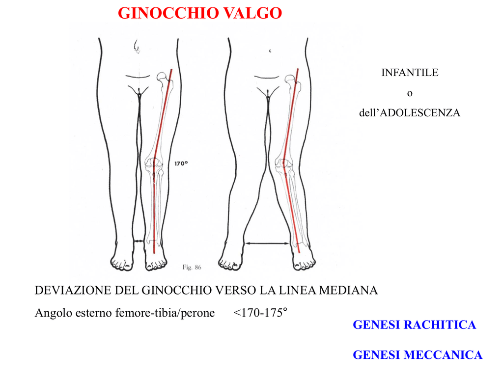 6 Ginocchio Valgo E Deformita Del Piede