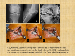monocompartimentale ginocchio