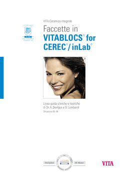 Faccette in VITABLOCS® for CEREC®/inLab®